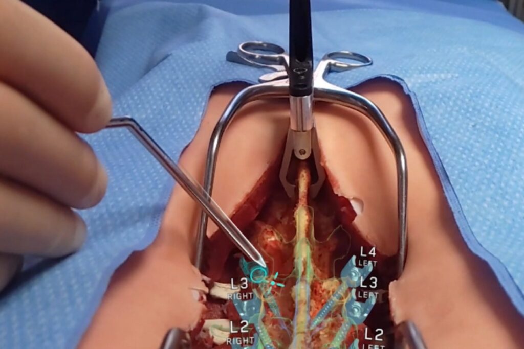 Neurocirugía asistida por realidad aumentada y inteligencia artificial con Medivis, mostrando navegación quirúrgica de la columna vertebral en tiempo real.